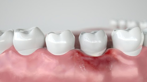 Caries in three stages – Stage 1 Gingivitis – 3D Rendering